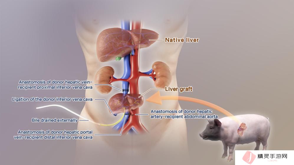 全球首例！中国团队成功将基因编辑猪肝脏移植到人体